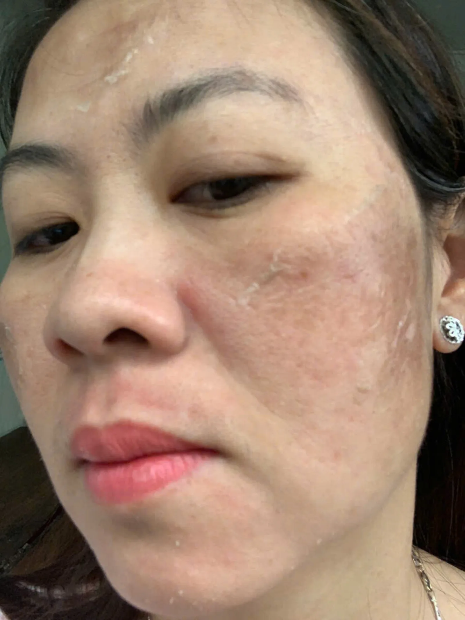 Mức bong da ngày thứ 6 — góc chụp thứ hai.